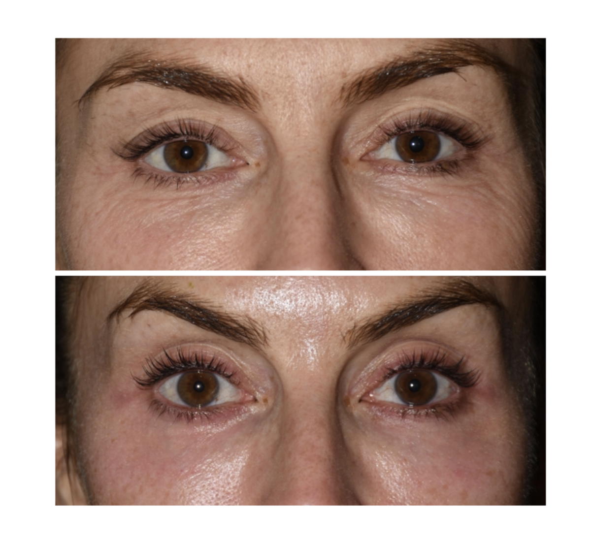 Before and after laser treatment