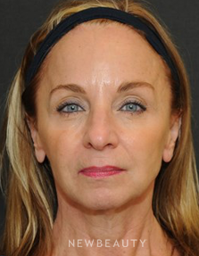 Dr. Janet Allenby- Botox - After