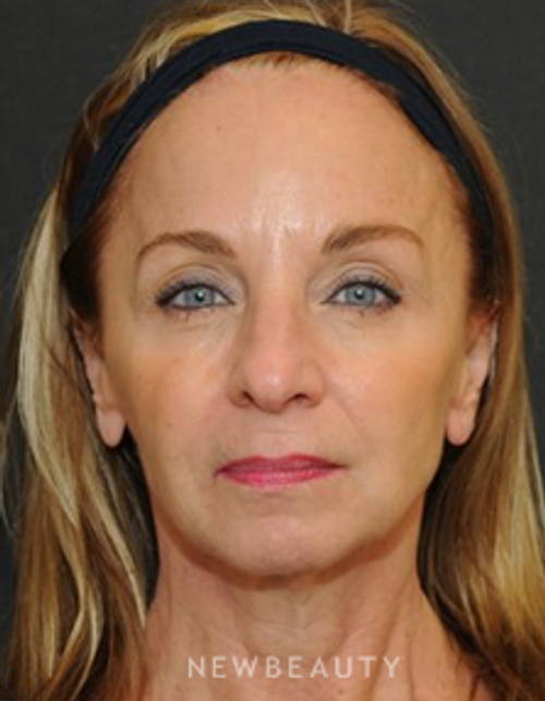 Dr. Janet Allenby- Botox - After