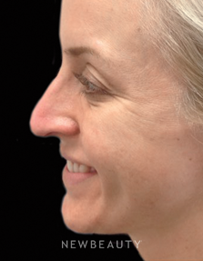 Dr. Julie Russak - Injectables & Fillers - After