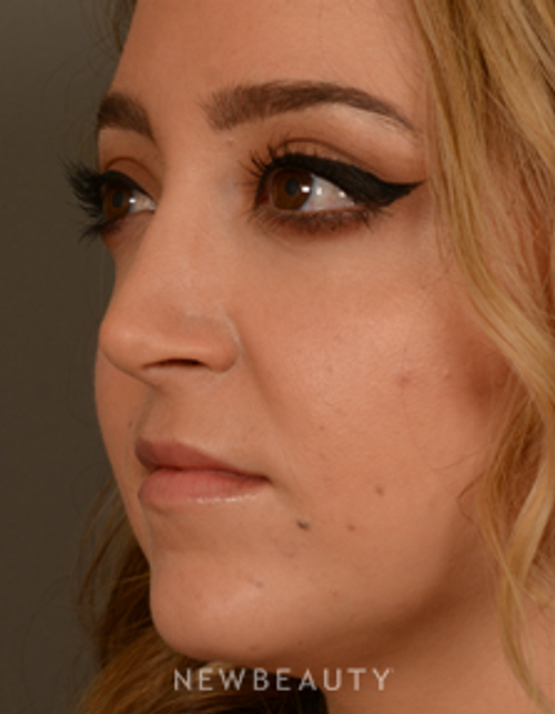 Dr. David Kim - Rhinoplasty - After
