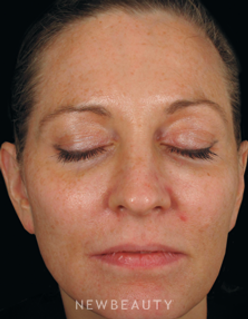 Dr. Gilly Munavalli Lasers - Before