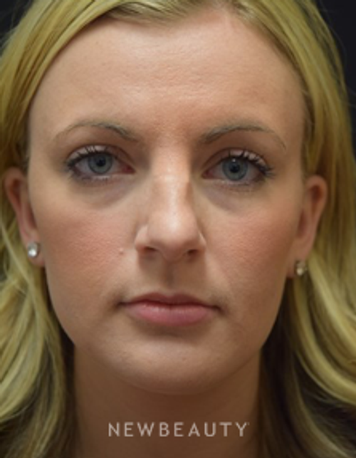 Dr. Jeffrey B. Wise - Rhinoplasty - Before