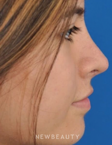 Dr. Edward Kwak - Revision Rhinoplasty - After