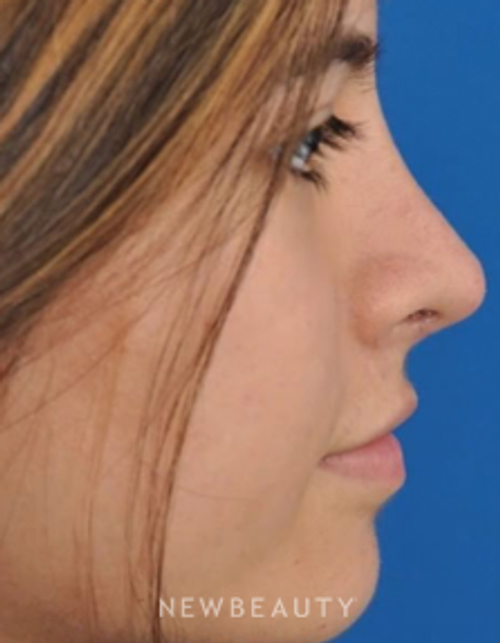 Dr. Edward Kwak - Revision Rhinoplasty - After