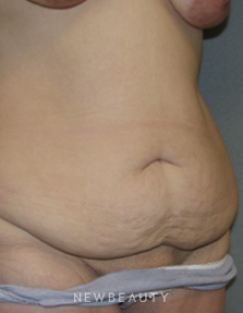 Dr. Sean Simon Breast Augmentation, Breast Lift, Liposuction, Tummy Tuck - Before