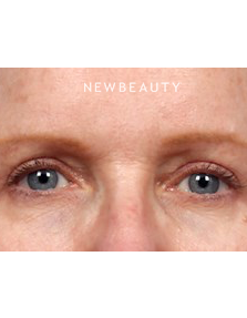 Dr. Kelly Bomer - Upper Blepharoplasty - After