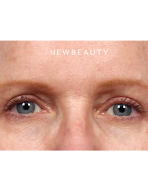 Dr. Kelly Bomer - Upper Blepharoplasty - After