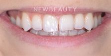 Dr. Nathan Hoffman - Smile Makeover - Before