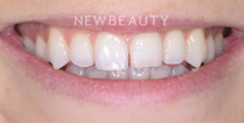 Dr. Nathan Hoffman - Smile Makeover - Before