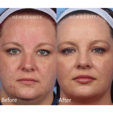 Microneedling before and after Image / Kelly Bomer