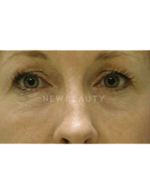 Dr. Phillip Chang Eyelift - Before