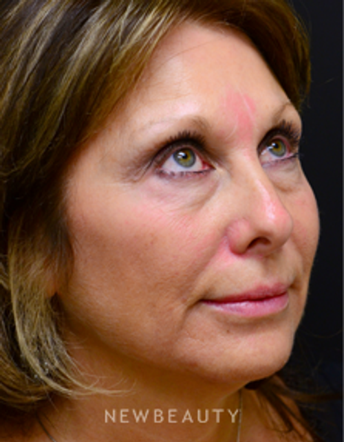 Dr. Mokhtar Asaadi Injectables & FIllers - Before