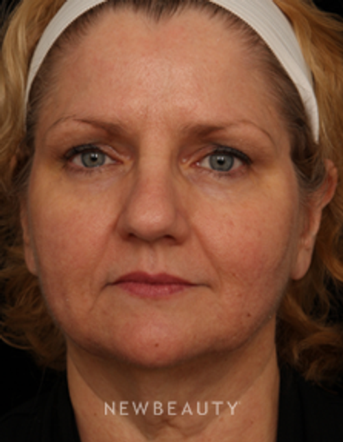 Dr. Jennifer M. Segal - Facial Rejuvenation - Before