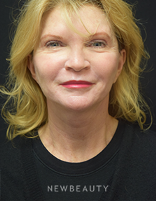 Dr. Jeffrey B. Wise - Facelift - After