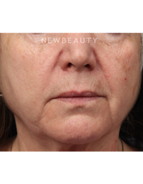 Dr. Kathleen Behr - Injectables & Fillers - Before