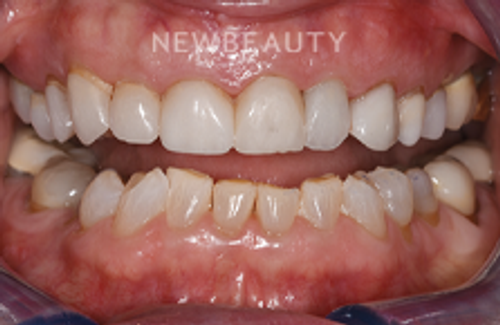 Dr. Sara Cummins - Smile Makeover - 14738160 - Before