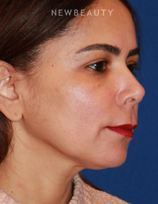 Dr. Dilip D. Madnani - Mini-Facelift - Before