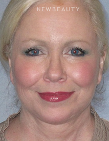 Dr. Henry Mentz III - An Award-Winning Facelift - After