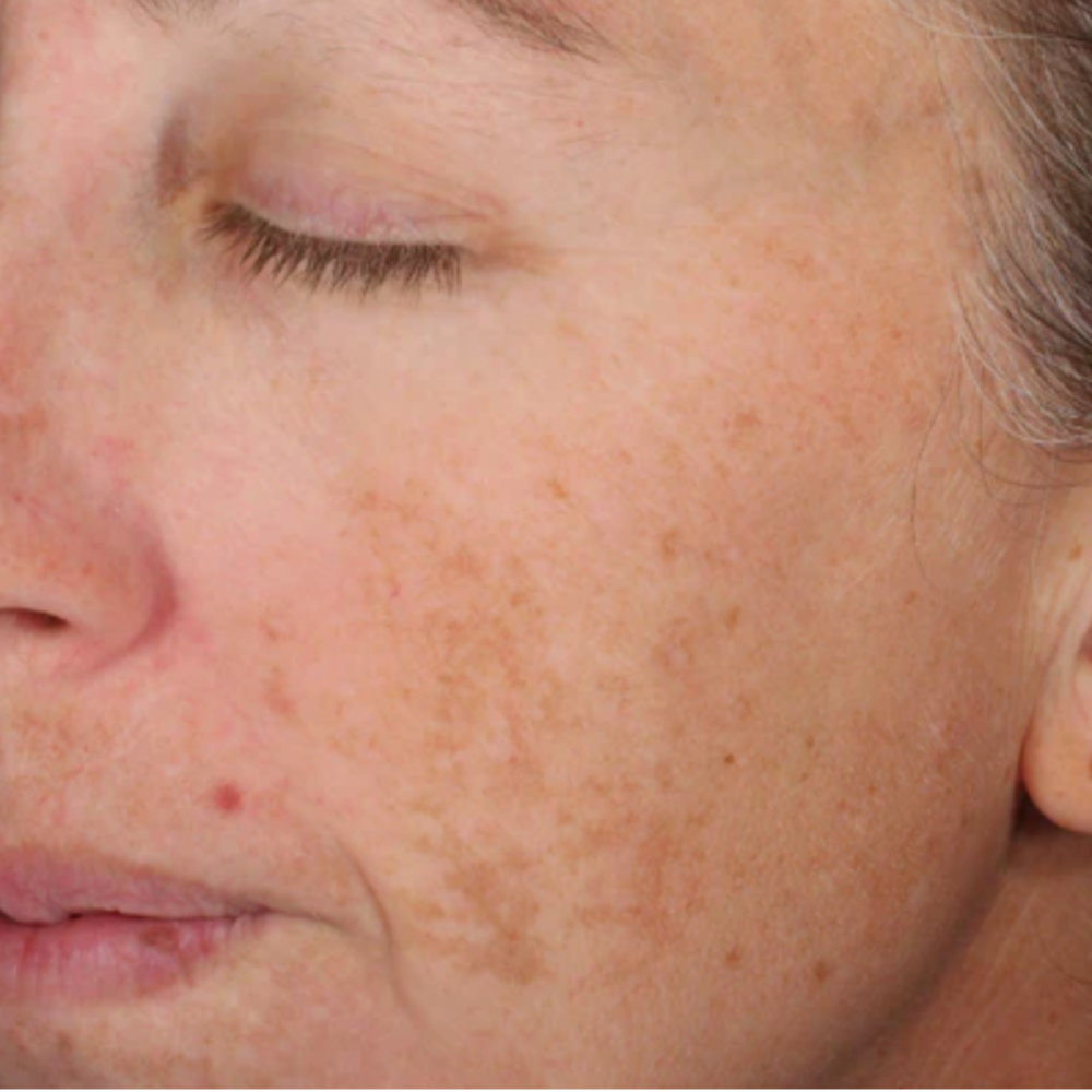 ALASTIN Skincare® Regimen: Gentle Cleanser, A-LUMINATE Brightening Serum™, Ultra Light Moisturizer, SPF 50 Sunscreen. Timeframe: 12 weeks. Photography courtesy of DMR Research, Westport, CT.