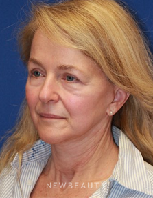 Dr. Dillip D. Madnani - Revision Necklift with Fat Transfer - Before