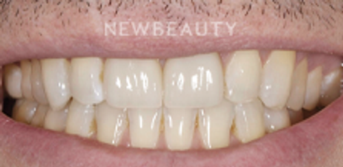 Dr. Salvator La Mastra – Smile Makeover – 46107091 - After