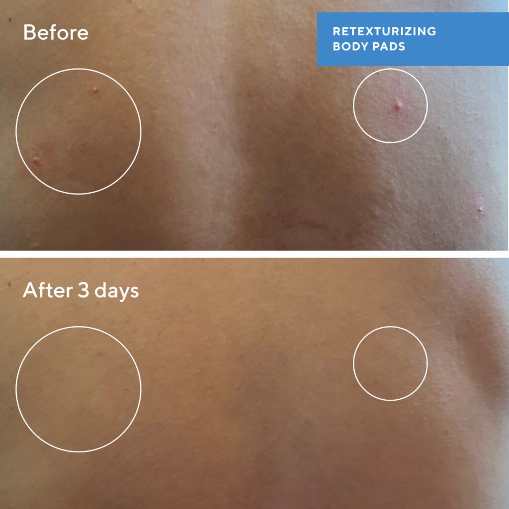 Before and After Murad Retexturizing Pads