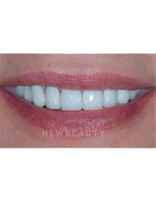 Dr. Guy Lewis Veneers - After