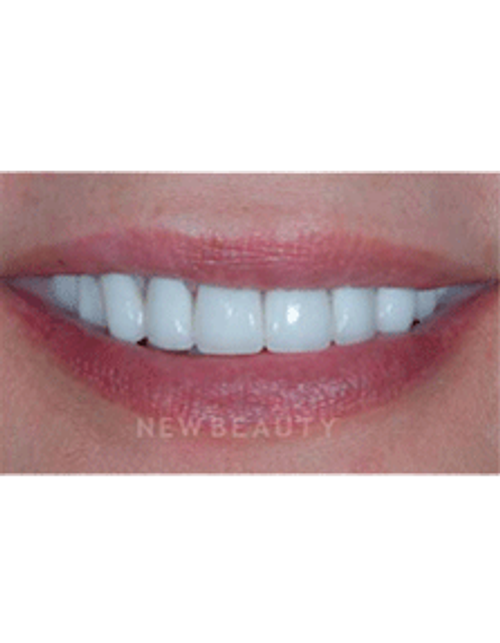 Dr. Guy Lewis Veneers - After