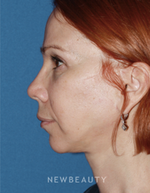 Dr. Konstantin Vasyukevich, Traditional Facelift - After