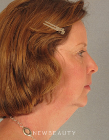Dr. Henry Mentz Eyelift, Facelift, Necklift - Before