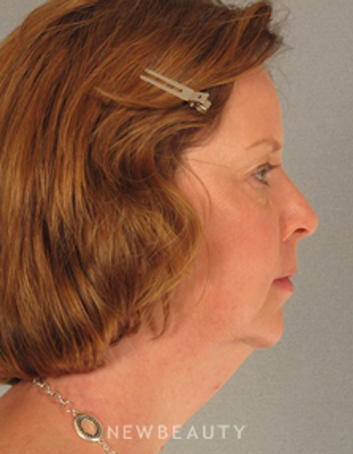 Dr. Henry Mentz Eyelift, Facelift, Necklift - Before