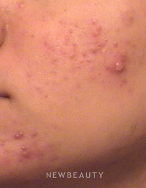 Dr. Tina Alster Lasers, Acne Treatment - Before