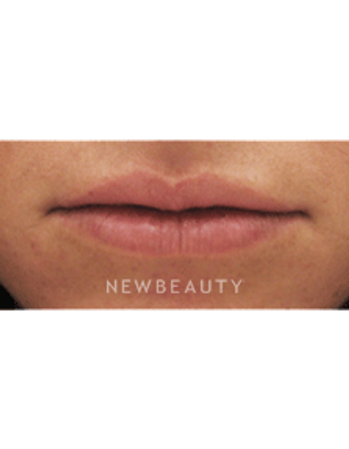 Dr Kenneth Beer Lip Augmention - After
