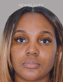 Dr. Anthony Bared - Rhinoplasty - 46164771 - After