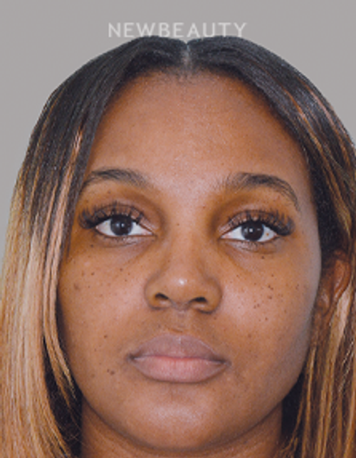 Dr. Anthony Bared - Rhinoplasty - 46164771 - After