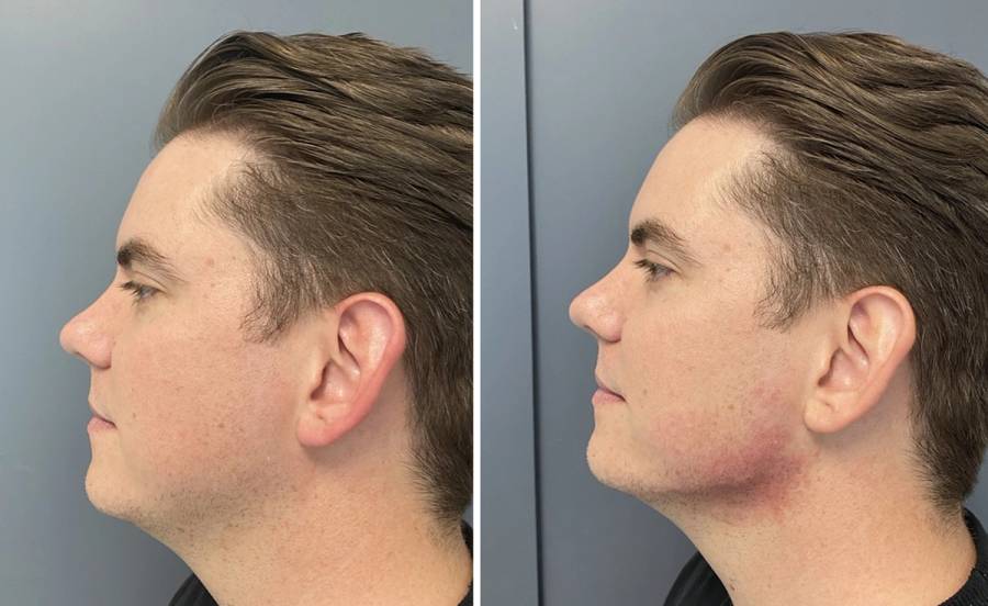 juvederm volux