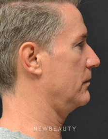 Dr. Julie Russak - CoolMini - Before