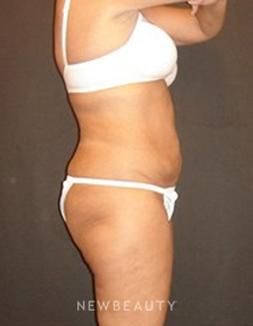 Dr. Joel Schlessinger - SmartLipo - After