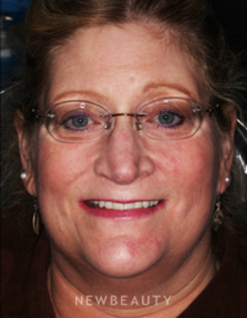 Dr. Neal Patel Smile Makeover, Dental Implants - After