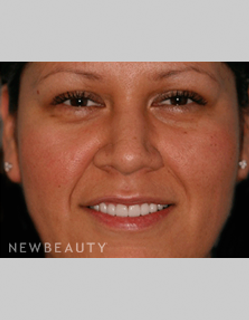 Dr. Bob Perkins Veneers - After