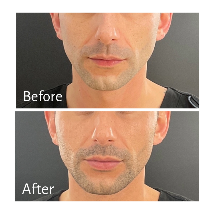 Strengthened Jaw