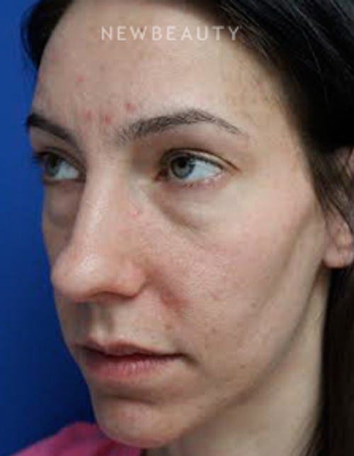Dr. Joseph Russo - Beautiful Results (Eye EBG) - Before