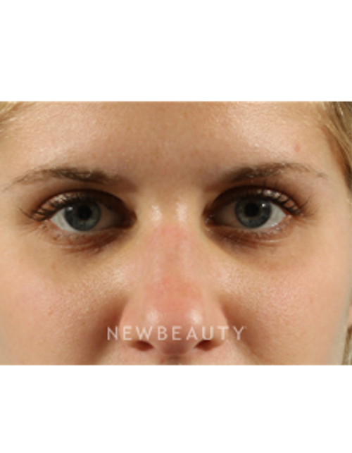 Dr. Marina Peredo - Latisse - After