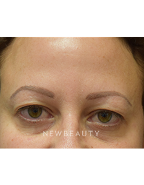 Dr. Jeffrey B. Wise - Upper Blepharoplasty - Before