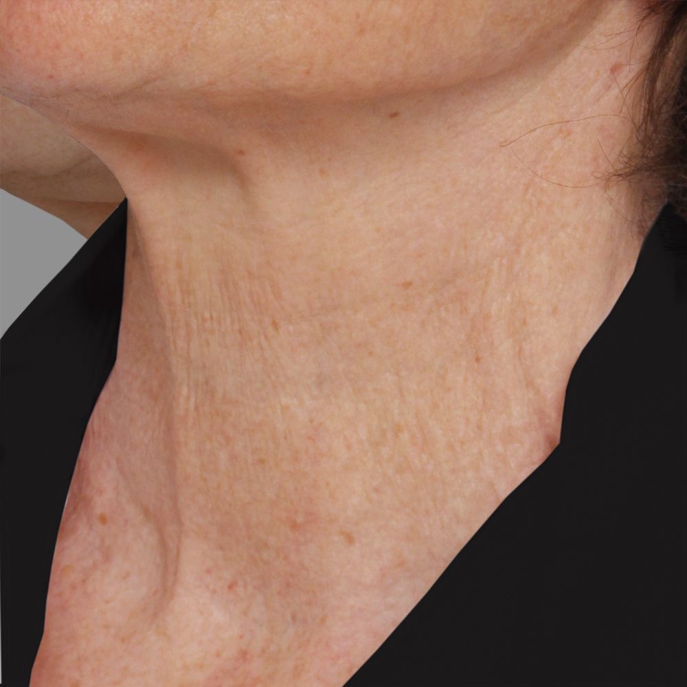 after skin-tightening treatments and Botox Cosmetic