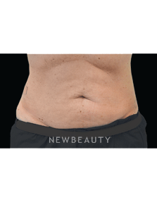 Dr. Julie Russack Fat Melters - Before