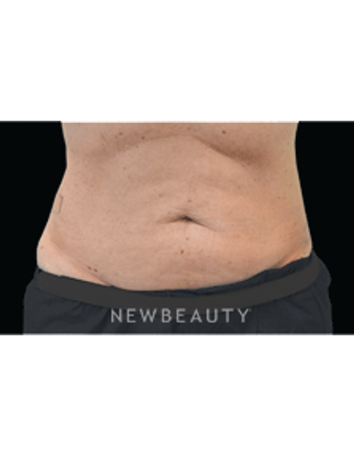 Dr. Julie Russack Fat Melters - Before