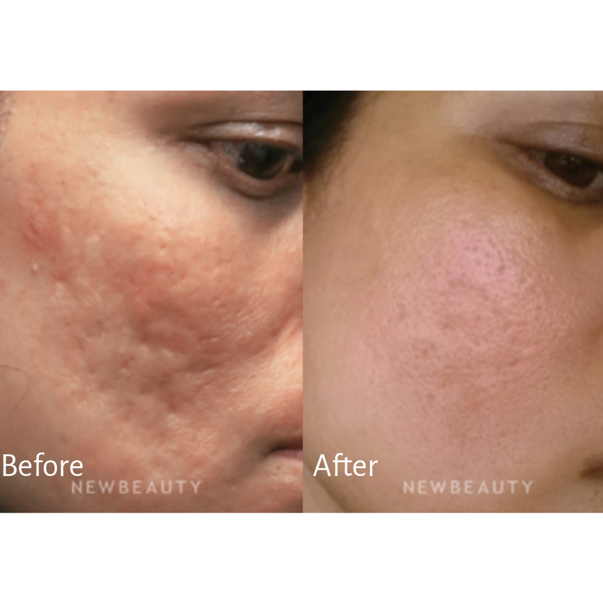 Dr. Levine treated this patient's acne scars with a custom laser resurfacing treatment.