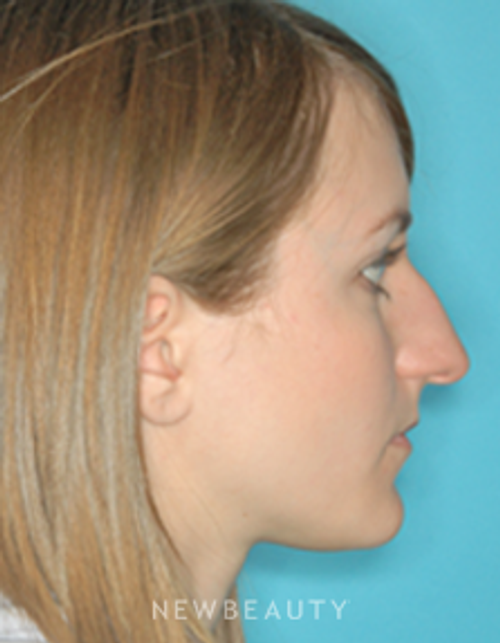Dr. David Kim Rhinoplasty - Before